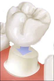 Porcelain implant - idealdentistryaz.com